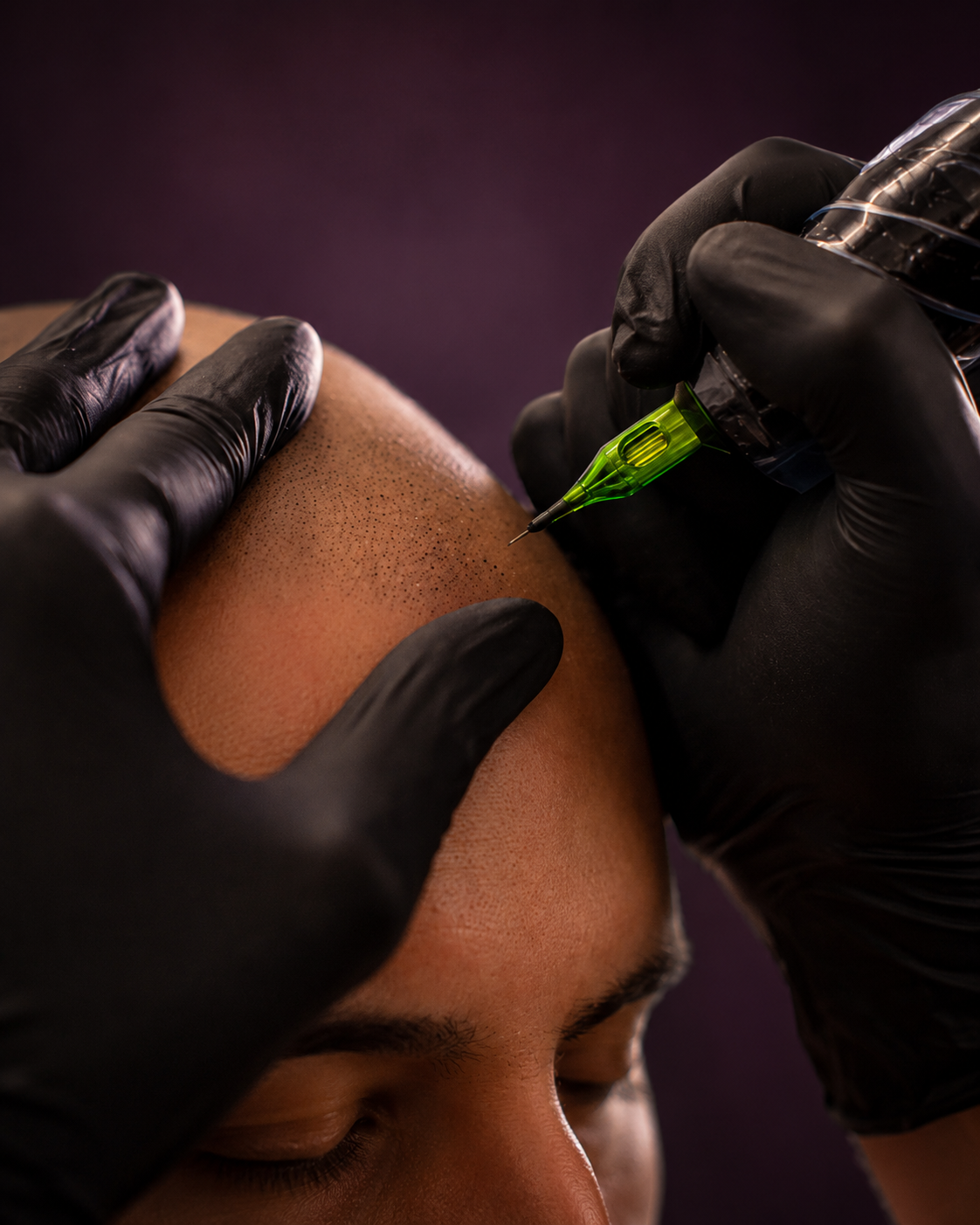 Full scalp micropigmentation creating an even shaved-head density